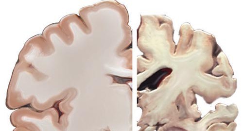Healthy brain and brain with severe AD